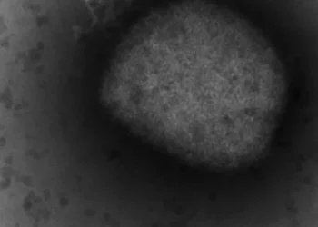 First monkeypox case reported in the region of Burlington, Milton, Oakville