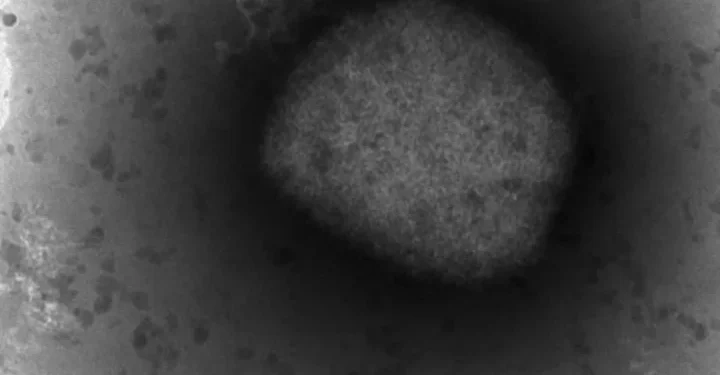 First monkeypox case reported in the region of Burlington, Milton, Oakville