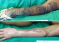 Brazilian Doctors Treat Burn Victims With Tilapia Skin