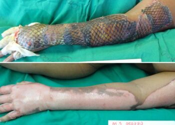 Brazilian Doctors Treat Burn Victims With Tilapia Skin