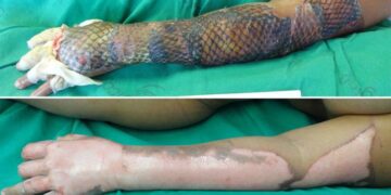 Brazilian Doctors Treat Burn Victims With Tilapia Skin