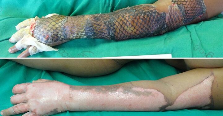 Brazilian Doctors Treat Burn Victims With Tilapia Skin