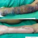 Brazilian Doctors Treat Burn Victims With Tilapia Skin