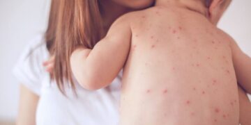 Measles Case Triggers Investigation and Public Alert in Peel Region