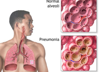 Practical Guide To Reducing The Risk of Pneumonia