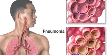Practical Guide To Reducing The Risk of Pneumonia