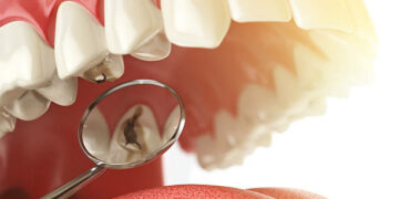 Natural Home Remedies for Tooth Decay and Cavities