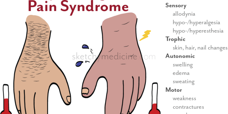 Redefining Pain: A Closer Look at Complex Regional Pain Syndrome