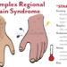 Redefining Pain: A Closer Look at Complex Regional Pain Syndrome