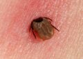 Canadian Patients Travel to Mexico for alternative Lyme disease treatments