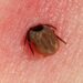 Canadian Patients Travel to Mexico for alternative Lyme disease treatments