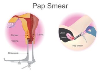 The Importance of Pap Smear: A Lifesaving Examination