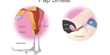 The Importance of Pap Smear: A Lifesaving Examination
