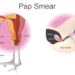 The Importance of Pap Smear: A Lifesaving Examination