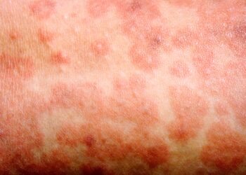 Measles Case confirmed in Calgary