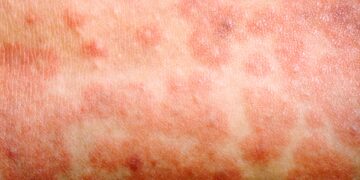 Measles Case confirmed in Calgary