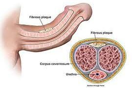 Unveiling Peyronie’s: Navigating the Curves of a Seldom-Discussed Condition