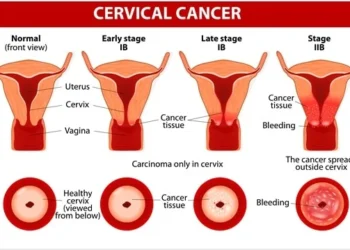 Cervical Cancer Cases increase in Canada