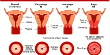 Cervical Cancer Cases increase in Canada
