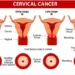 Cervical Cancer Cases increase in Canada