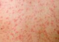Ontario could be witnessing ‘sporadic’ community transmission of measles